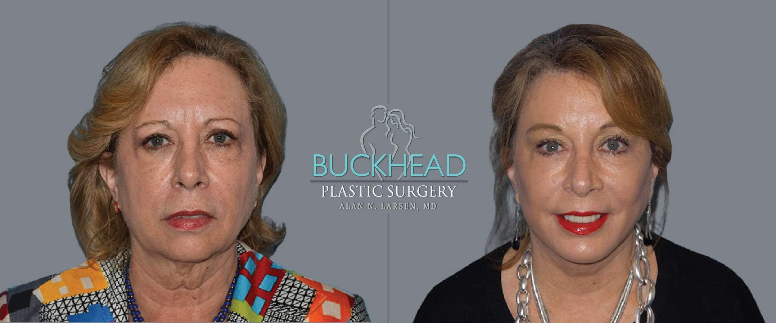 Before and After Photo Gallery | Blepharosty | Buckhead Plastic Surgery | Alan N. Larsen, MD | Double Board-Certified Plastic Surgeon | Atlanta GA