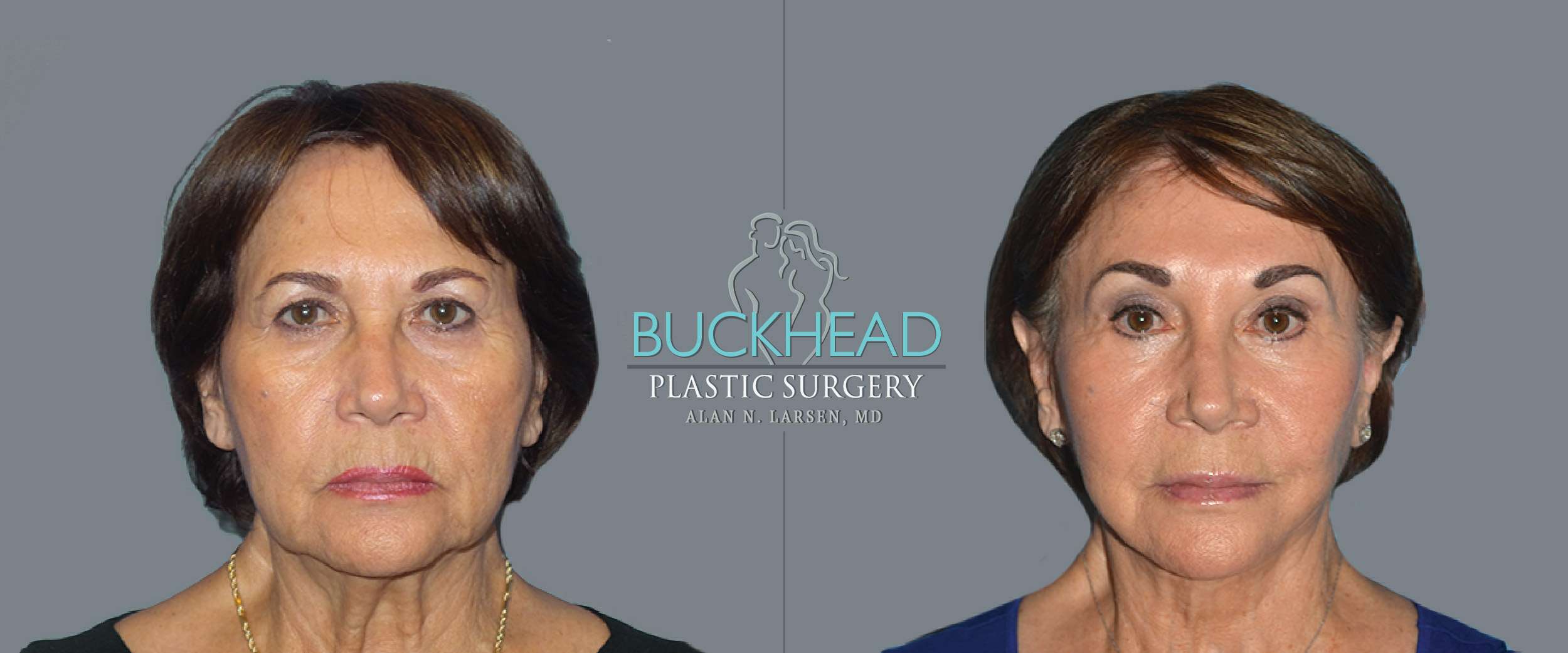 Before and After Photo Gallery | Blepharosty | Buckhead Plastic Surgery | Alan N. Larsen, MD | Double Board-Certified Plastic Surgeon | Atlanta GA