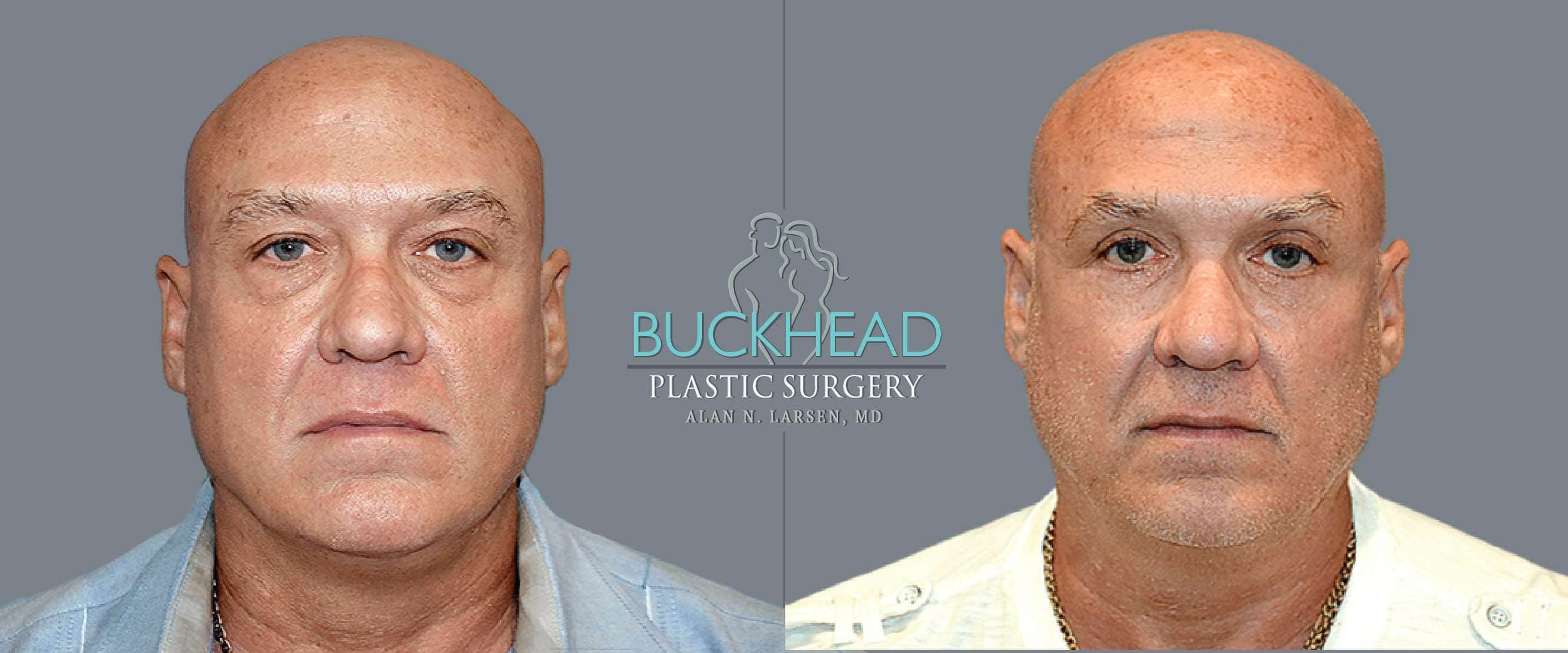 Before and After Photo Gallery | Blepharosty | Buckhead Plastic Surgery | Alan N. Larsen, MD | Double Board-Certified Plastic Surgeon | Atlanta GA