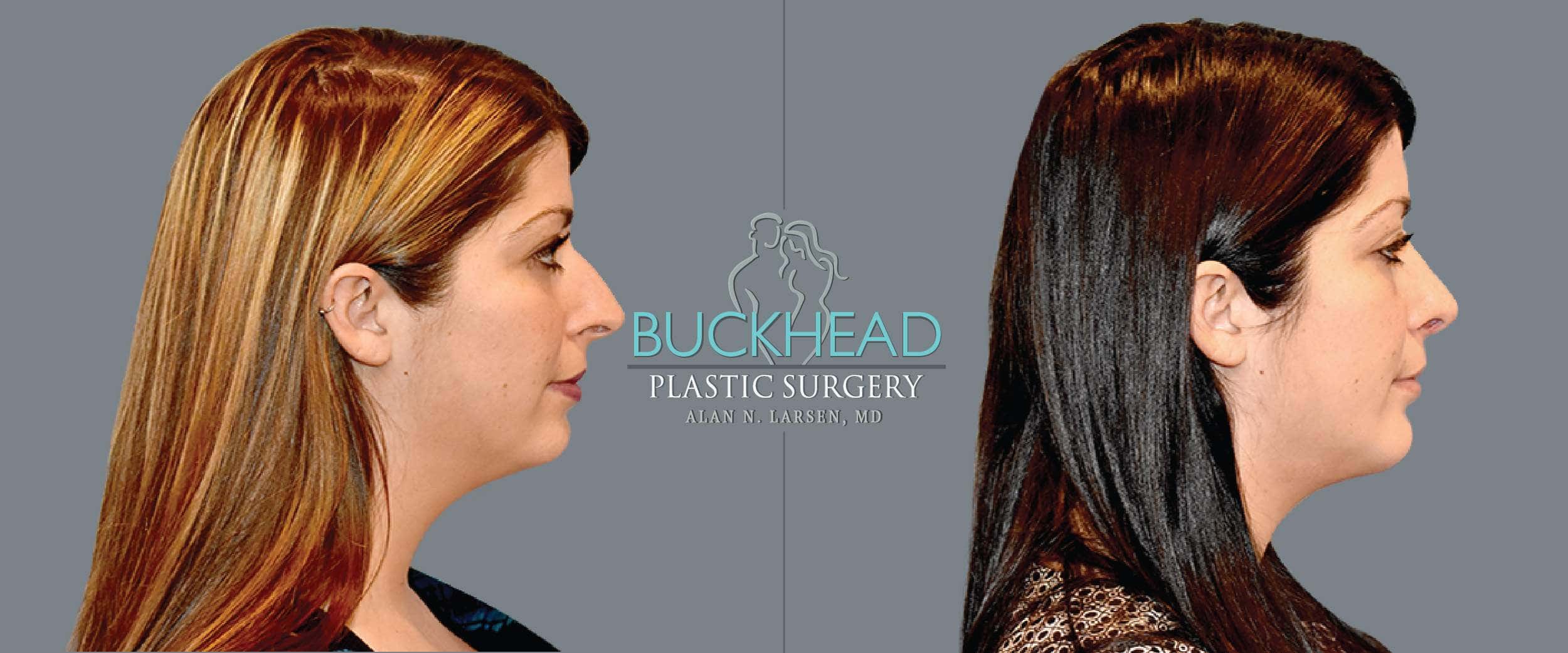 Before and After Photo gallery | Rhinoplasty | Buckhead Plastic Surgery | Double Board-Certified Plastic Surgeon in Atlanta GA