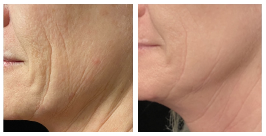 Opus Plasma at Buckhead Plastic Surgery in Atlanta offers visible results after as few as one treatment