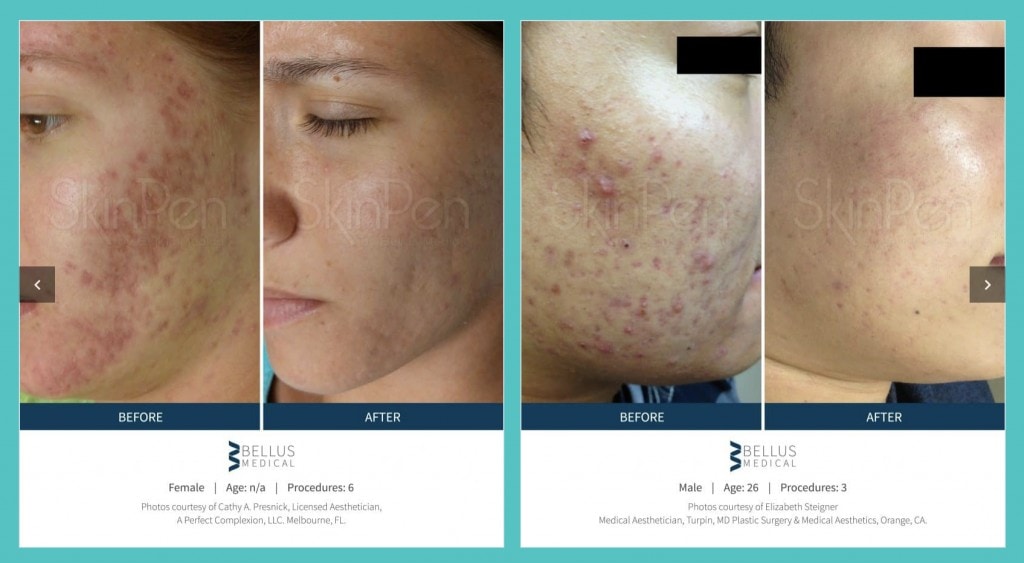 microneedling-at-lux-med-spa at buckhead plastic surgery