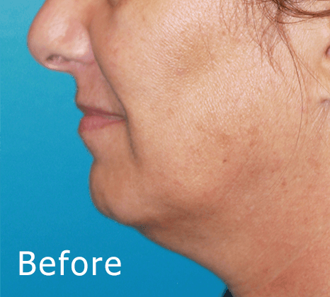 Chin Augmentation | Buckhead Plastic Surgery In Atlanta, GA