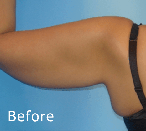 Arm Lift | Buckhead Plastic Surgery In Atlanta, GA