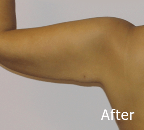 Arm Lift | Buckhead Plastic Surgery In Atlanta, GA